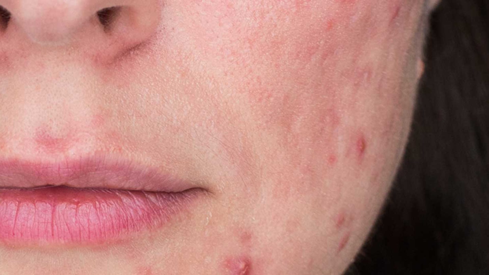 Rosacea | Ihre Hautärzte in Feldmeilen lindern Ihre Symptome
